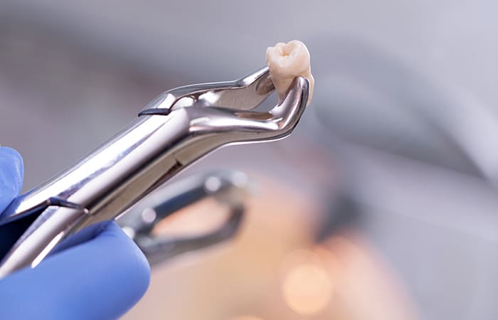難症例の抜歯にも対応可能